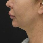 Neck Lift Before & After Patient #1389
