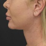 Neck Lift Before & After Patient #1389
