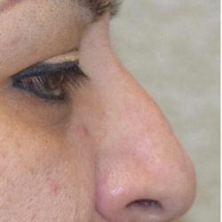 Rhinoplasty Before & After Patient #1586