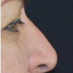 Rhinoplasty Before & After Patient #1586