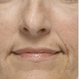 Radiesse Before & After Patient #1486