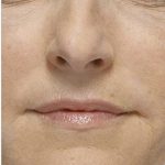Radiesse Before & After Patient #1486