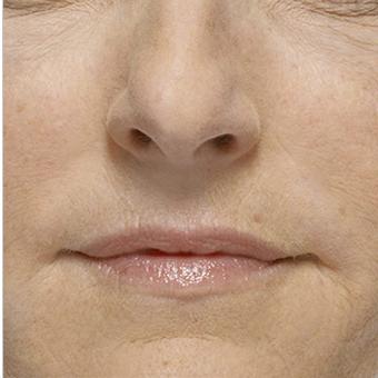Radiesse Before & After Patient #1486