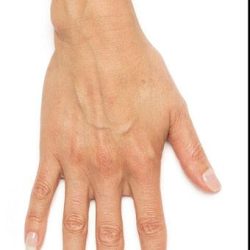 Radiesse Before & After Patient #1487