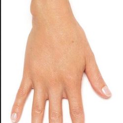 Radiesse Before & After Patient #1487