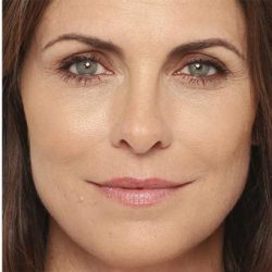 Radiesse Before & After Patient #1488