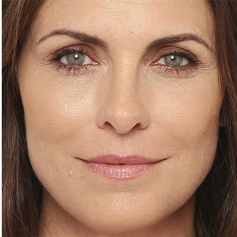 Radiesse Before & After Patient #1488