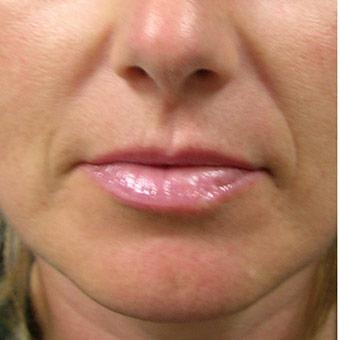 Restylane & Juvederm Before & After Patient #1393