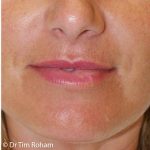 Restylane & Juvederm Before & After Patient #1393