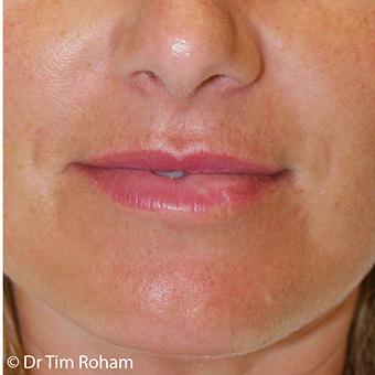 Restylane & Juvederm Before & After Patient #1393