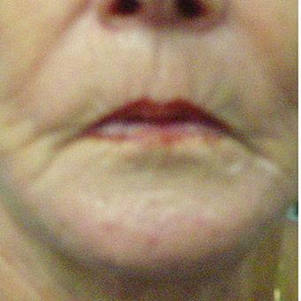 Restylane & Juvederm Before & After Patient #1394