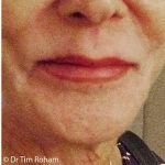 Restylane & Juvederm Before & After Patient #1394