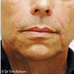 Restylane & Juvederm Before & After Patient #1395