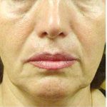 Restylane & Juvederm Before & After Patient #1396