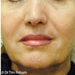 Restylane & Juvederm Before & After Patient #1396