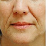 Restylane & Juvederm Before & After Patient #1397