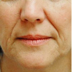 Restylane & Juvederm Before & After Patient #1397