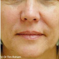 Restylane & Juvederm Before & After Patient #1397