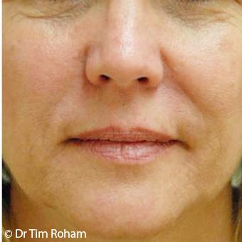 Restylane & Juvederm Before & After Patient #1397