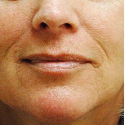 Restylane & Juvederm Before & After Patient #1398