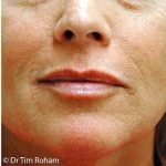 Restylane & Juvederm Before & After Patient #1398