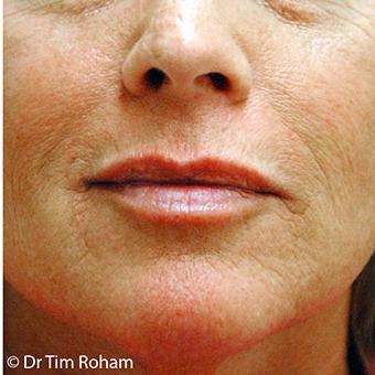 Restylane & Juvederm Before & After Patient #1398