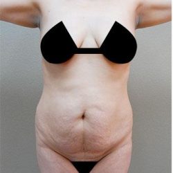 Tummy Tuck Before & After Patient #1209