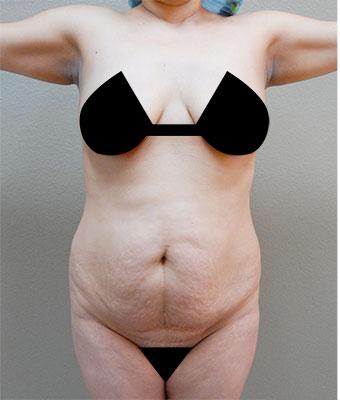 Tummy Tuck Before & After Patient #1209