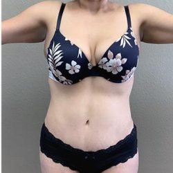 Tummy Tuck Before & After Patient #1209