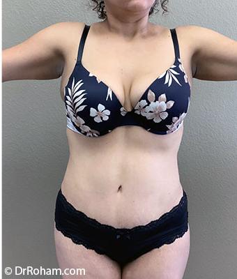 Tummy Tuck Before & After Patient #1209