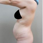 Tummy Tuck Before & After Patient #1209