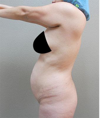 Tummy Tuck Before & After Patient #1209