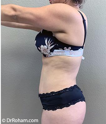 Tummy Tuck Before & After Patient #1209