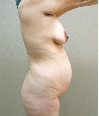 Tummy Tuck Before & After Patient #1210