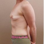 Tummy Tuck Before & After Patient #1212