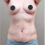 Tummy Tuck Before & After Patient #1213