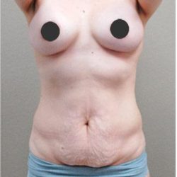 Tummy Tuck Before & After Patient #1213