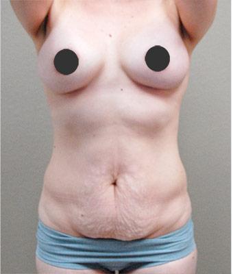 Tummy Tuck Before & After Patient #1213