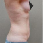 Tummy Tuck Before & After Patient #1213