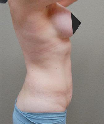 Tummy Tuck Before & After Patient #1213