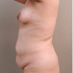 Tummy Tuck Before & After Patient #1214