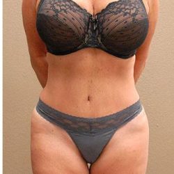 Tummy Tuck Before & After Patient #1215