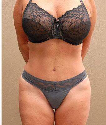 Tummy Tuck Before & After Patient #1215