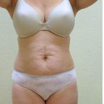 Tummy Tuck Before & After Patient #1216