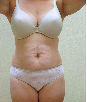 Tummy Tuck Before & After Patient #1216