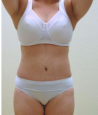 Tummy Tuck Before & After Patient #1216