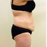 Tummy Tuck Before & After Patient #1217