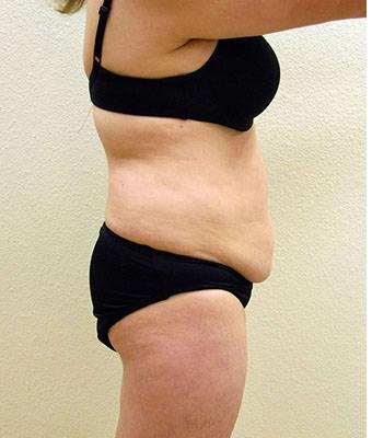 Tummy Tuck Before & After Patient #1217
