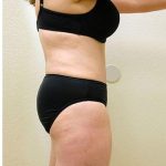 Tummy Tuck Before & After Patient #1217