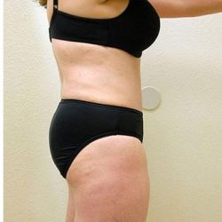 Tummy Tuck Before & After Patient #1217